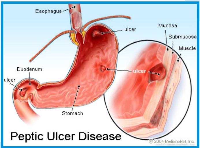 ulcer peptic